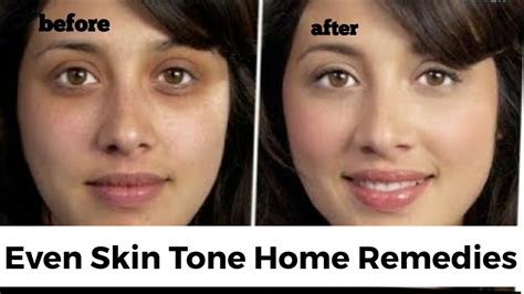 Home Remedies For Uneven Skin Tone For All Skin Types All Skin