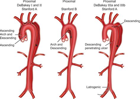 Aortic Dissection Most Spacious Biog Picture Galleries