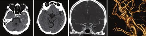 Computed Tomography Ct Scans Showing Acute Subdural Hematoma