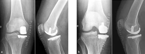 Pdf Periprosthetic Fracture Of The Tibial Plateau After