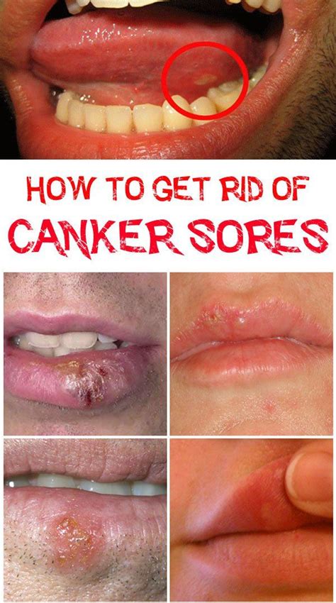 Herpes Sore On Tongue Pictures Hsvtongue Ozemedicine Wiki For