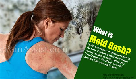 What Is Mold Rash And How Is It Treated Symptoms Risk Factors