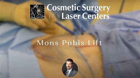 Mons Pubis Lift Reverse Abdominoplasty Debulking With Liposuction