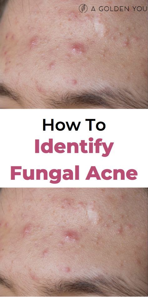 How To Get Rid Of Fungal Acne Marks