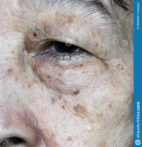 Small Brown Patches Called Age Spots On Face Of Asian Elder Woman They