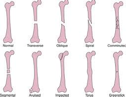 Explain Bone Fractures