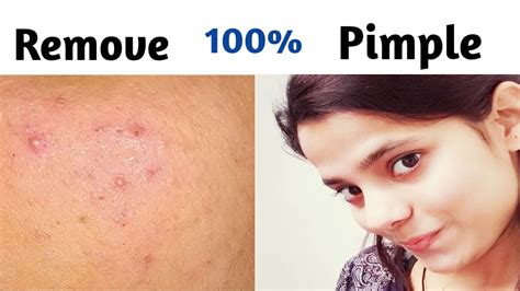 How To Remove Pimple Remove Pimples Naturally Remove Pimple Youtube