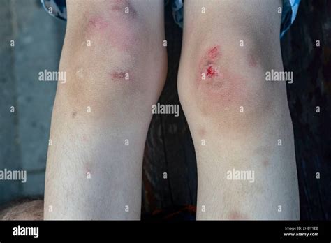 Skin Scrape Knee Child Hi Res Stock Photography And Images Alamy