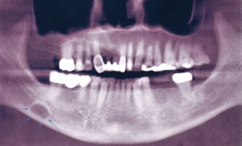 Rare Stafne Bone Cavity In The Bilateral Ramus Of The Mandible A Case