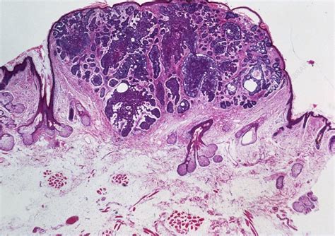 Lm Of A Section Of Basal Cell Carcinoma Stock Image M1320205