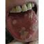 Oral Lesions In An Immunocompromised Patient  The BMJ