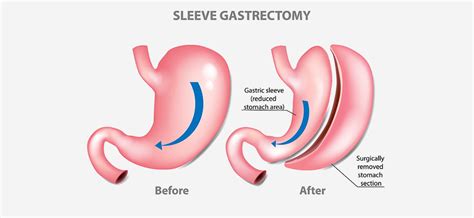 Sleeve Gastrectomy Lapband Surgery