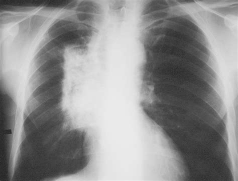 Learningradiology Radiation Fibrosis Pneumonitis