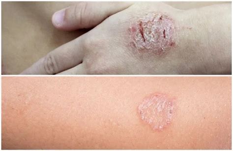 Best Homeopathic Treatment For Tinea Corporis Ringworm