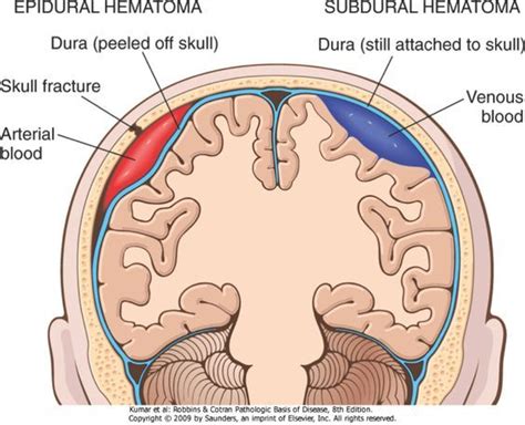 What Is The Difference Between An Epidural Hematoma And A Subdural