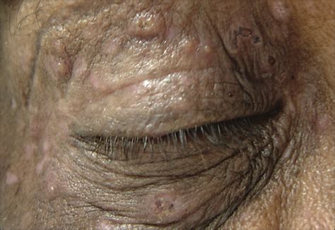Periorbital Papulovesicular Eruption In An Elderly Man—quiz Case