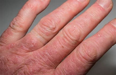Understanding Eczema Arthritis Rheumatoid Causes And Treatments