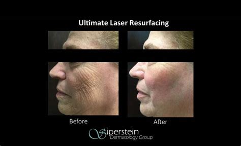 Laser Skin Resurfacing Will Make You Look 10 Years Younger