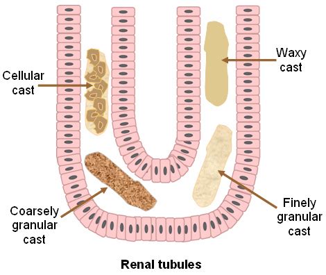 Cast Formation In The Renal Tubules Eclinpath
