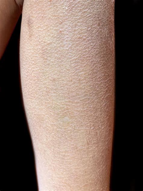 Dry Cracking Leg Skin Winter Stock Photos Free And Royalty Free Stock