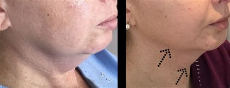 Double Chin Fat Dissolving Vistaclinic