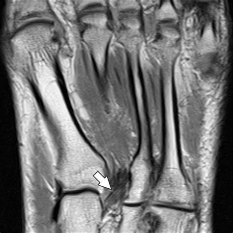 Evaluation Of The Tarsometatarsal Joint Using Conventional Radiography