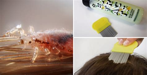 How To Get Rid Of Nits And Head Lice Bathmost9