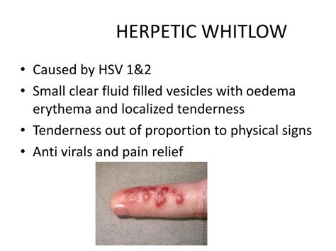Ppt Hand Infections Powerpoint Presentation Free Download Id2323448