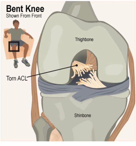 Acl Series Mechanism Get Well Physical Therapy