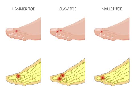 Treatment Of Foot Deformities Foot Deformity Correction Market