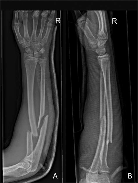Ap A And Lateral B Forearm X Ray Of Patient 3 Showing A Dislocated