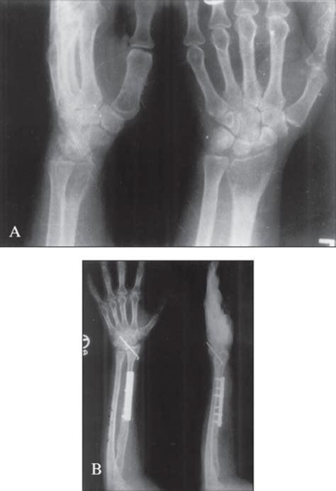 A Preoperative X Ray A P And Lateral Of Wrist Shows Open I