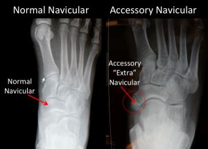 Accessory Navicular Syndrome Os Tibiale Externum Oc Foot And Ankle