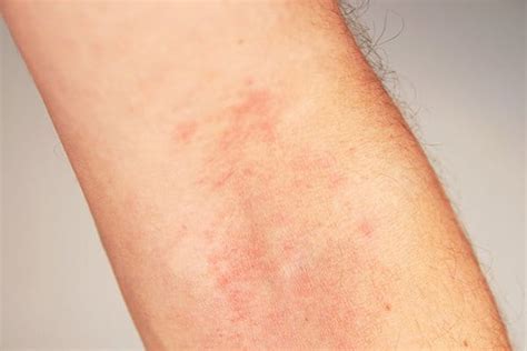 Atopic Dermatitis Eczema The Symptoms Eucerin