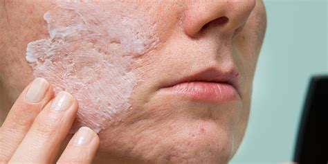 Treatments For Acne Scarring Norris Dermatology Portland Or