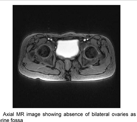 Figure 1 From The Role Of Mri In The Management Of Cases Of Mayer