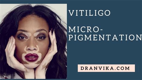 Micropigmentation For Vitiligo Dr Anvika Youtube