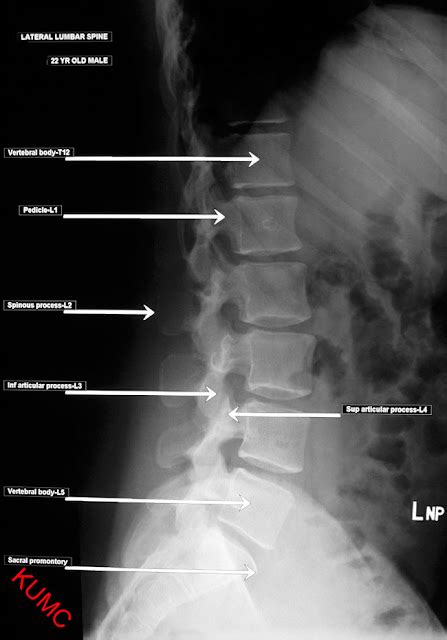 Labeled Anatomy Of Lumbar Spine