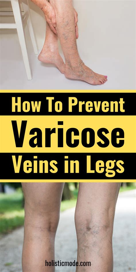 How To Prevent Varicose Veins In Thighs Unugtp