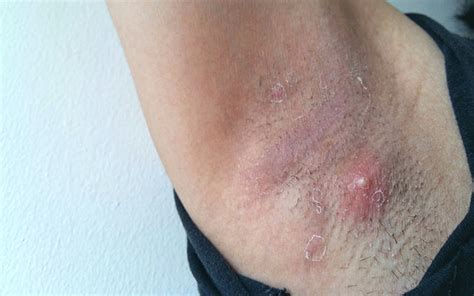 Armpit Pimples Causes Symptoms Diagnosis Treatment Prevention Healthroid