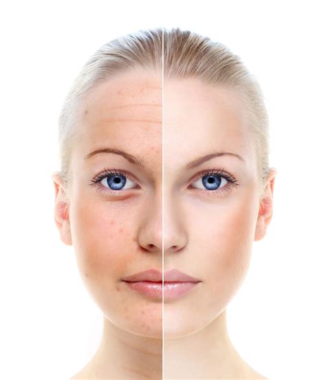Treating Brown And Age Spots With Photorejuvenation Elkhart In