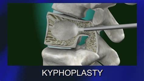 Kyphoplasty Explained By Dr Fernandez Youtube