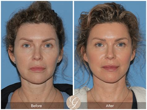 Lower Facelift Deep Plane Necklift Case Before After Photos Orange County