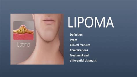What Is The Difference Between Lipoma And Cancer