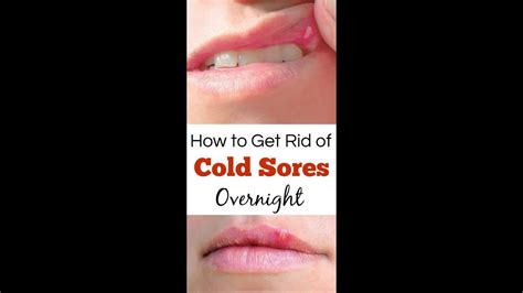 How To Get Rid Of Cold Sores Permanently Youtube