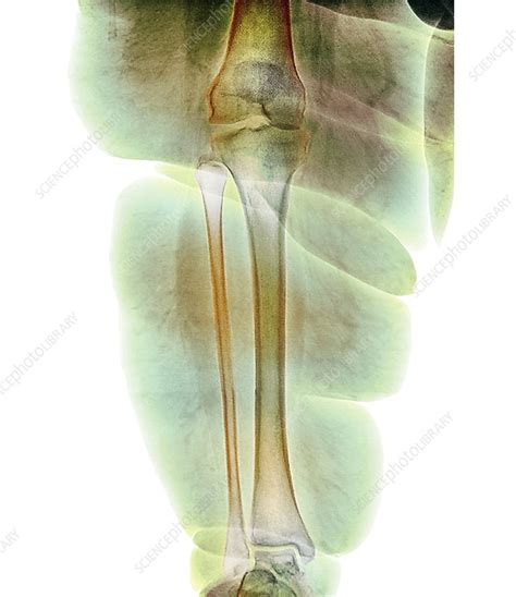 Obese Persons Leg X Ray Stock Image M2300535 Science Photo Library
