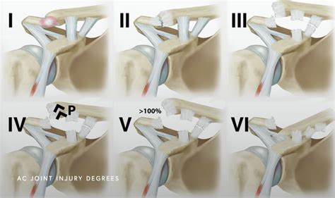 Ac Joint Injury Chicago Il Dr Jorge Chahla