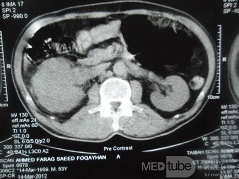 Right Renal Cell Carcinoma Image