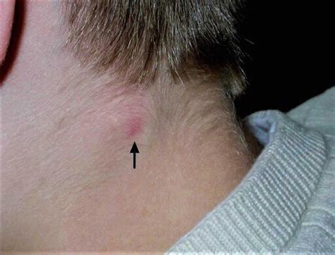 Moveable Lump On Back Of Childs Head Shiloh Hardesty