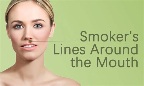 Smokers Lines Around The Mouth Treatment In Surat Elegance Clinic